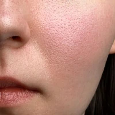 textured skin